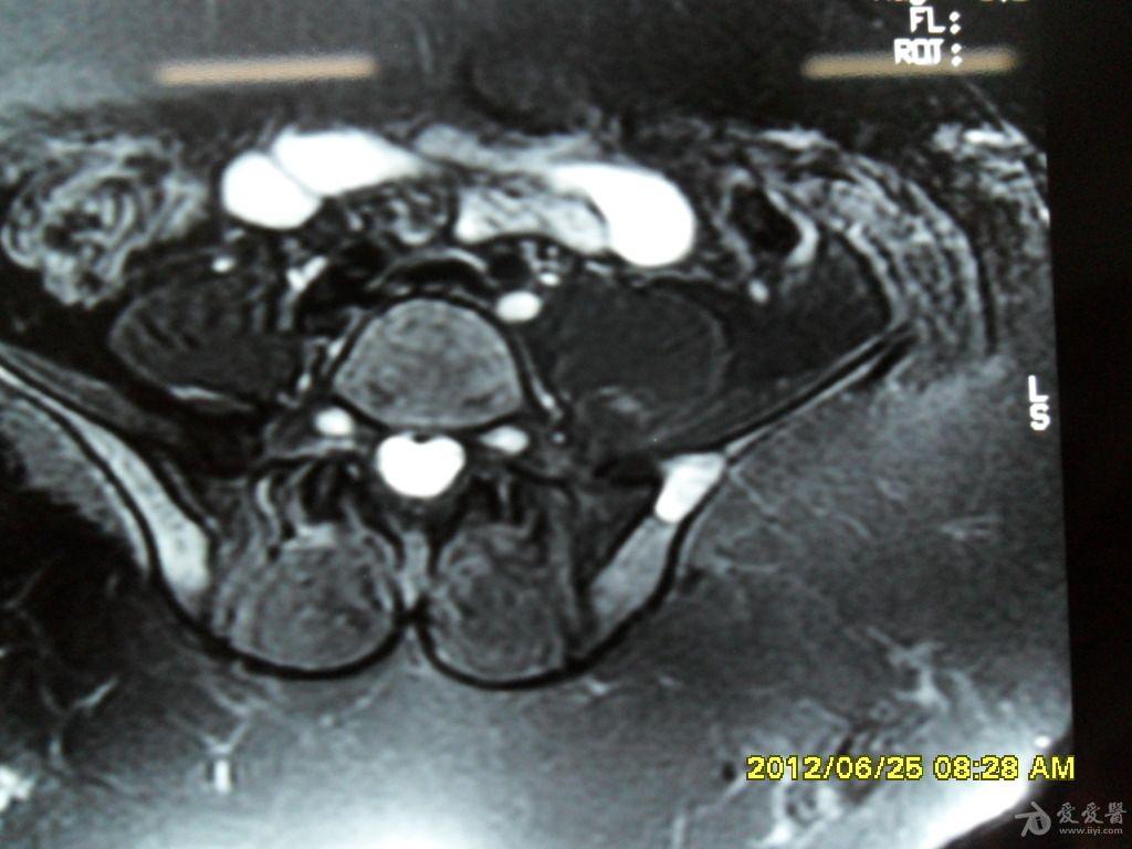 髂骨病变,ct,mri检查,请讨论!
