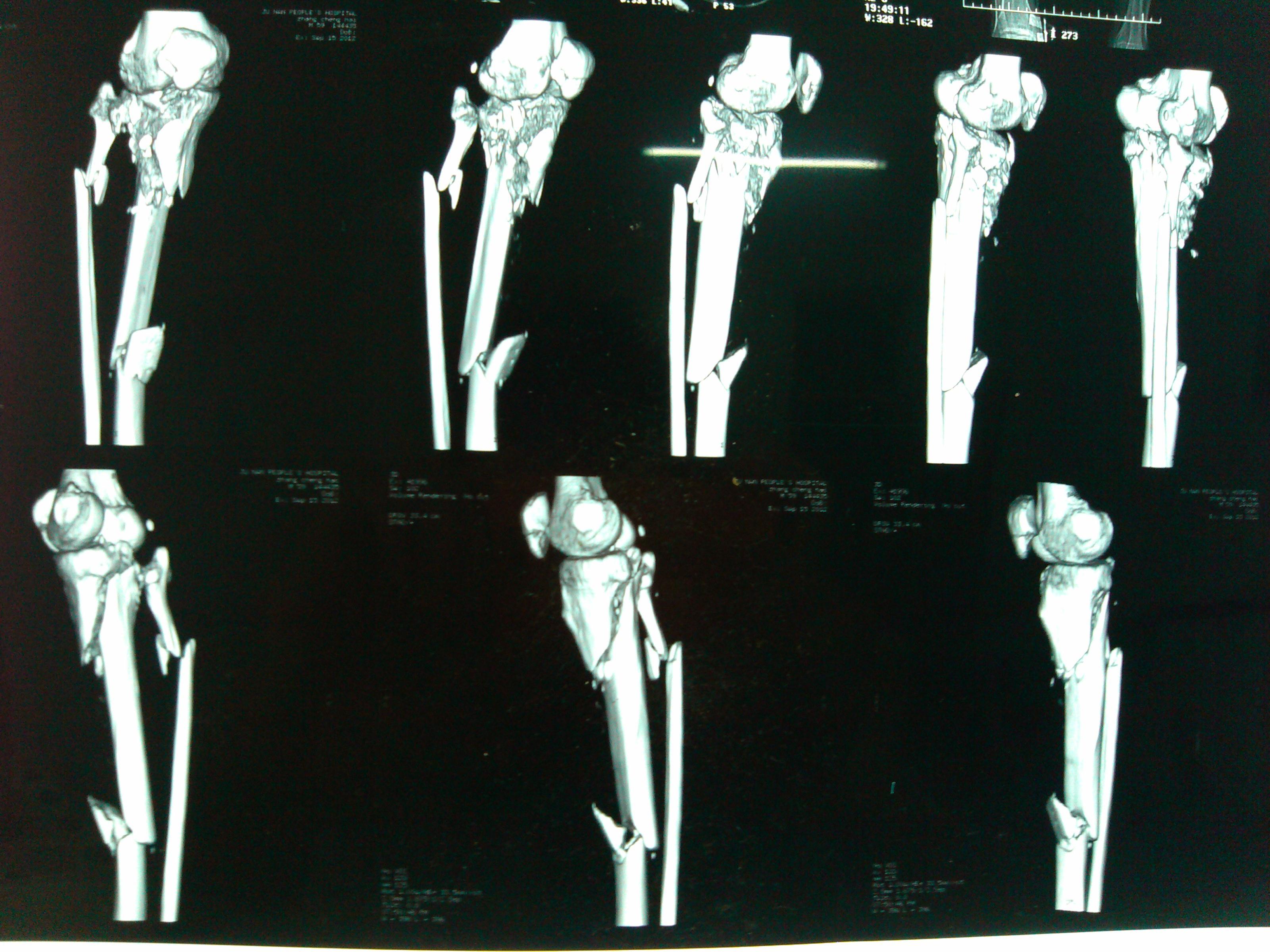 胫骨多段骨折