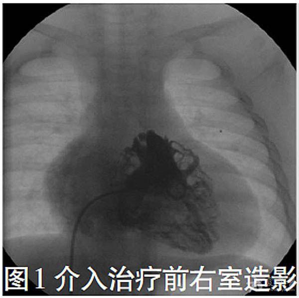 右心室流出道呈管型,肺动脉膜性闭锁(图1,主肺动脉发育正常,肺动脉