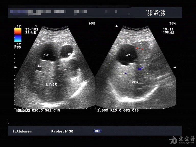 典型多囊肾,多囊肝一例 超声医学讨论版 爱爱医医学论坛