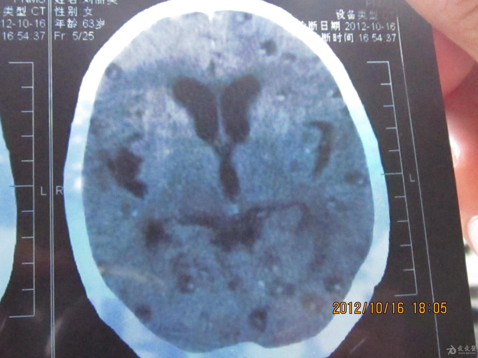 求助脑囊虫病