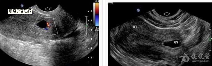 子宫疤痕妊娠 - 超声医学讨论版 - 爱爱医医学论坛