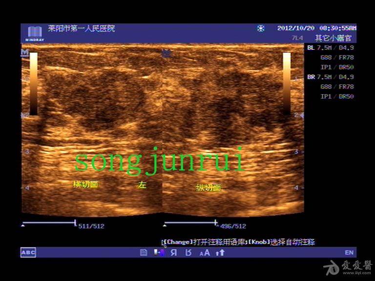 乳腺癌伴腋窝淋巴结转移 超声医学讨论版 爱爱医医学论坛