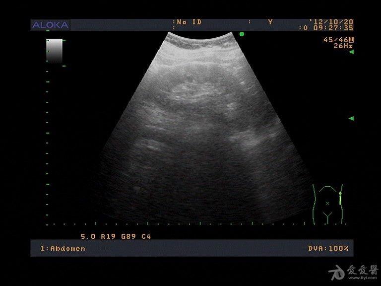 肝肾隐窝囊肿? - 超声医学讨论版 - 爱爱医医学论坛