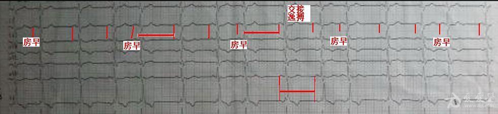 支持楼上诊断,本图符合房早三联律伴右束支阻滞.