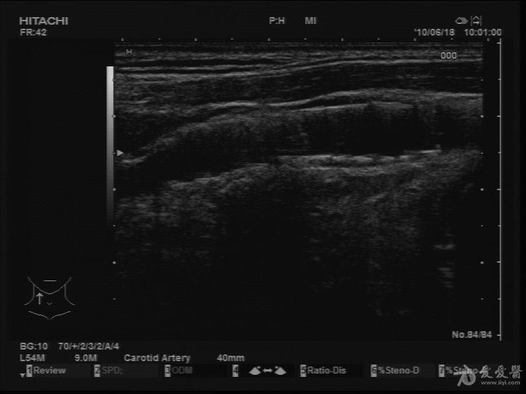 颈动脉放支架后的超声图像