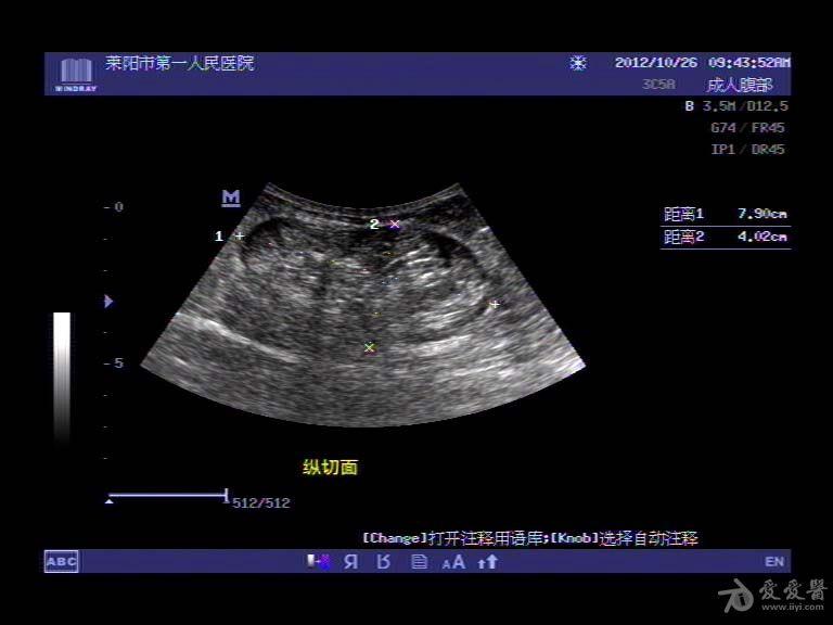 腹壁疝(体表 超声图) - 超声医学讨论版 - 爱爱医医学