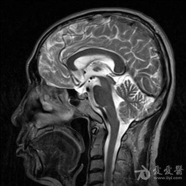 左侧桥小脑角区占位?(ct mri平扫)