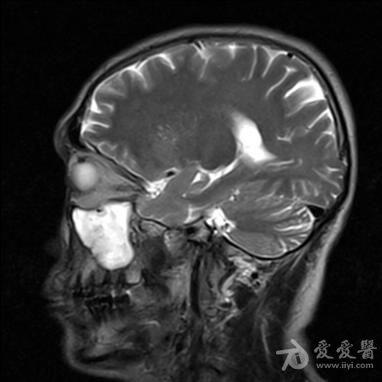 左侧桥小脑角区占位?(ct mri平扫)