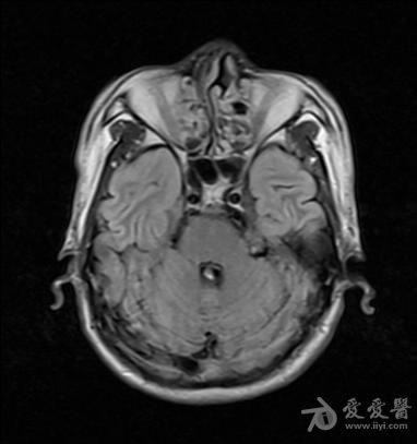 左侧桥小脑角区占位ctmri平扫