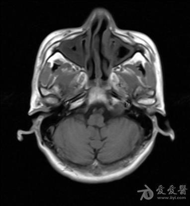 左侧桥小脑角区占位ctmri平扫