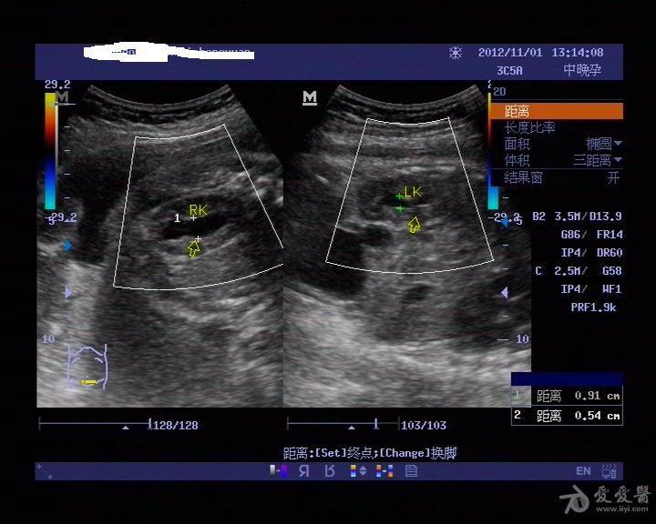 这个胎儿肾脏有问题吗 超声医学讨论版 爱爱医医学论坛