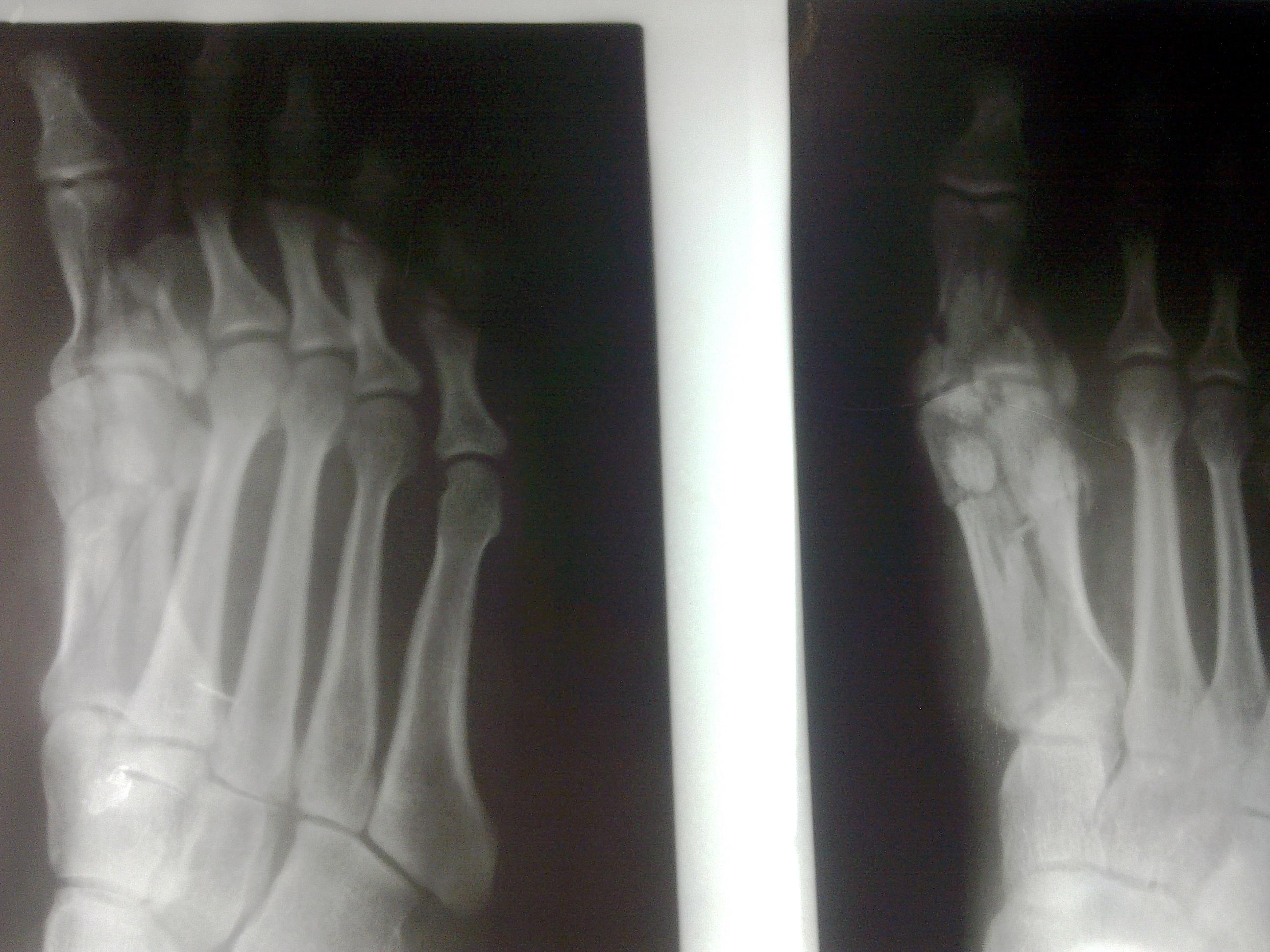 左足第一跖趾骨粉碎性骨折