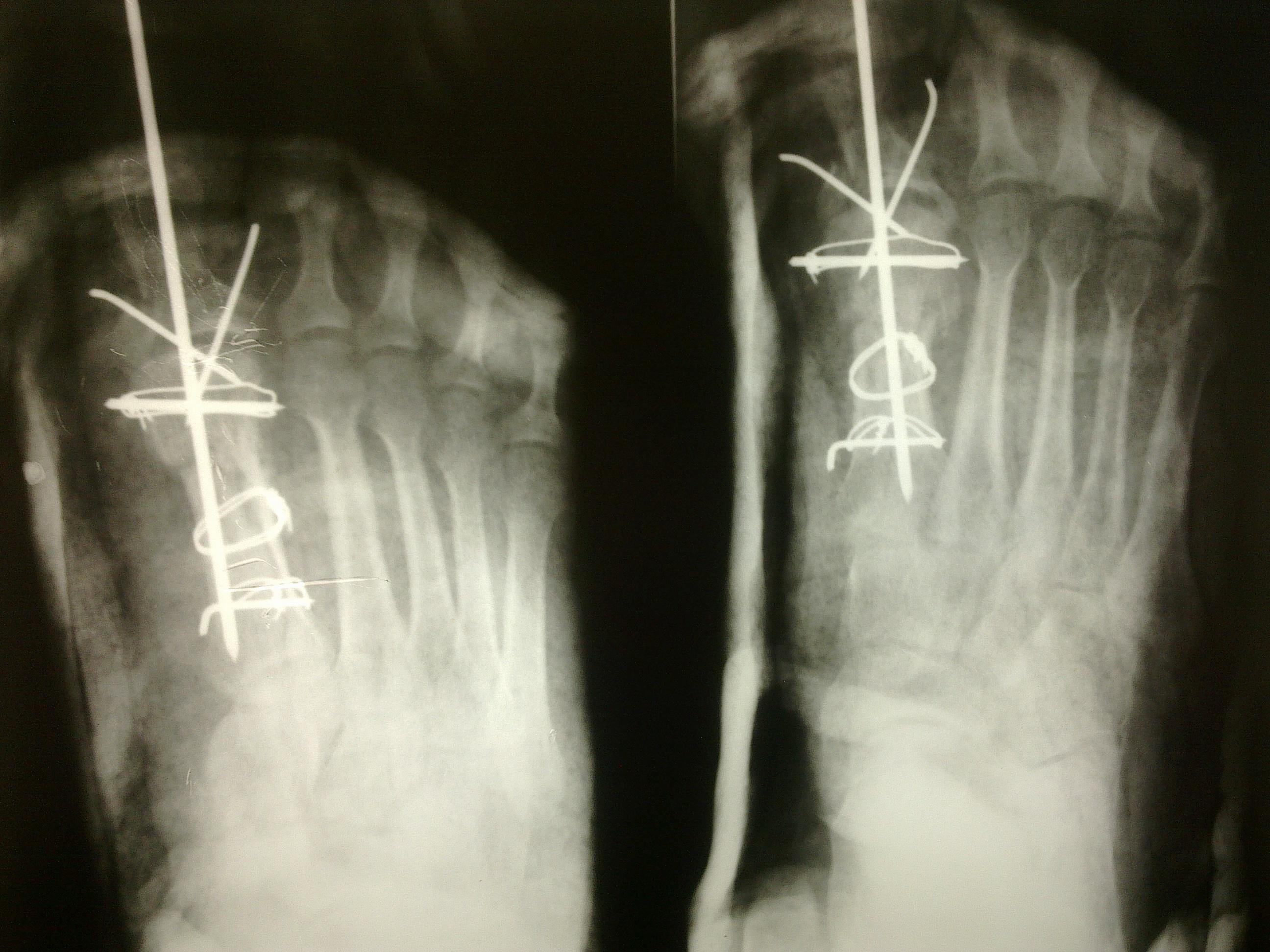 左足第一跖趾骨粉碎性骨折