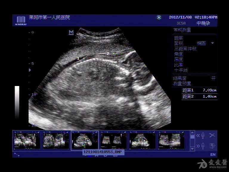 胎儿颈部水囊状淋巴管瘤 - 超声医学讨论版 - 爱爱医
