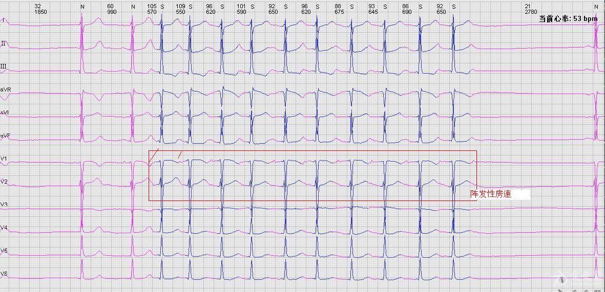 病窦综合症 - 心电图脑电图专业讨论版 - 爱爱医医学