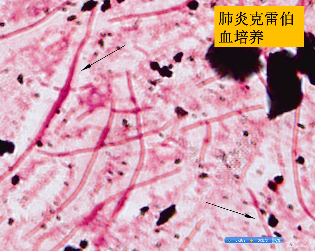 记得以前周庭银教授的学习班上曾经展示过类似的肺炎克雷伯菌,不