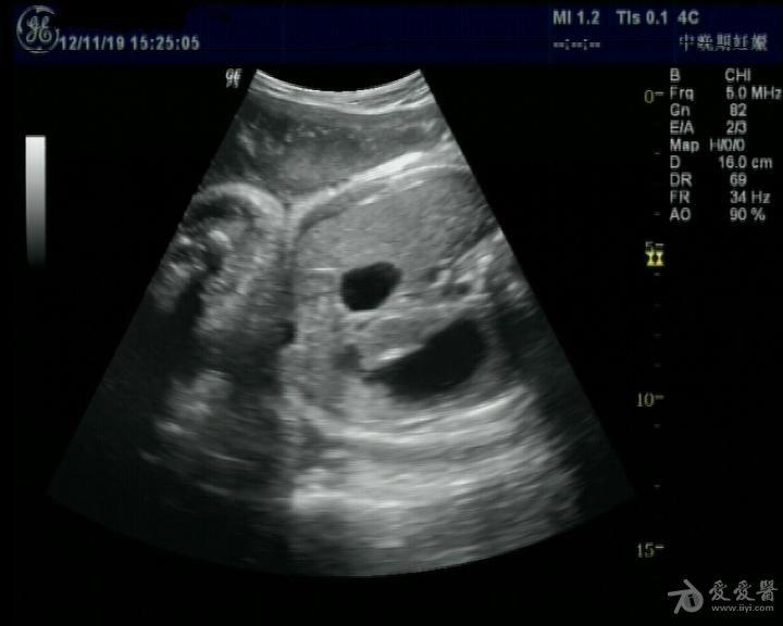胎儿腹部双泡征