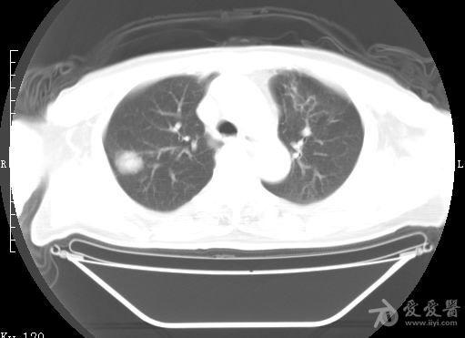 结核球?周围型肺ca?