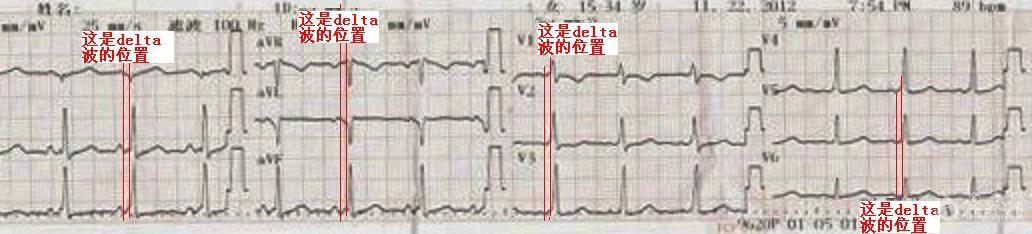 请大家帮忙分析一下这心电图