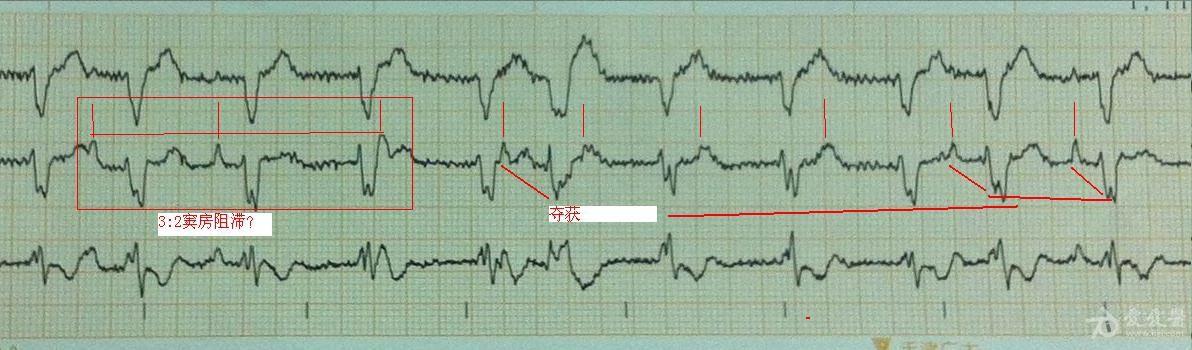 男,44岁,室速,室颤复律后心电图,原有先心肺动脉狭窄.jpg
