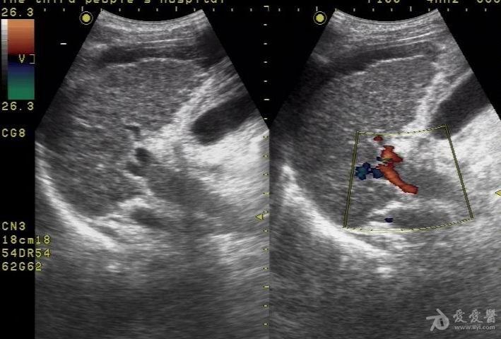 门静脉实性占位 超声医学讨论版 爱爱医医学论坛