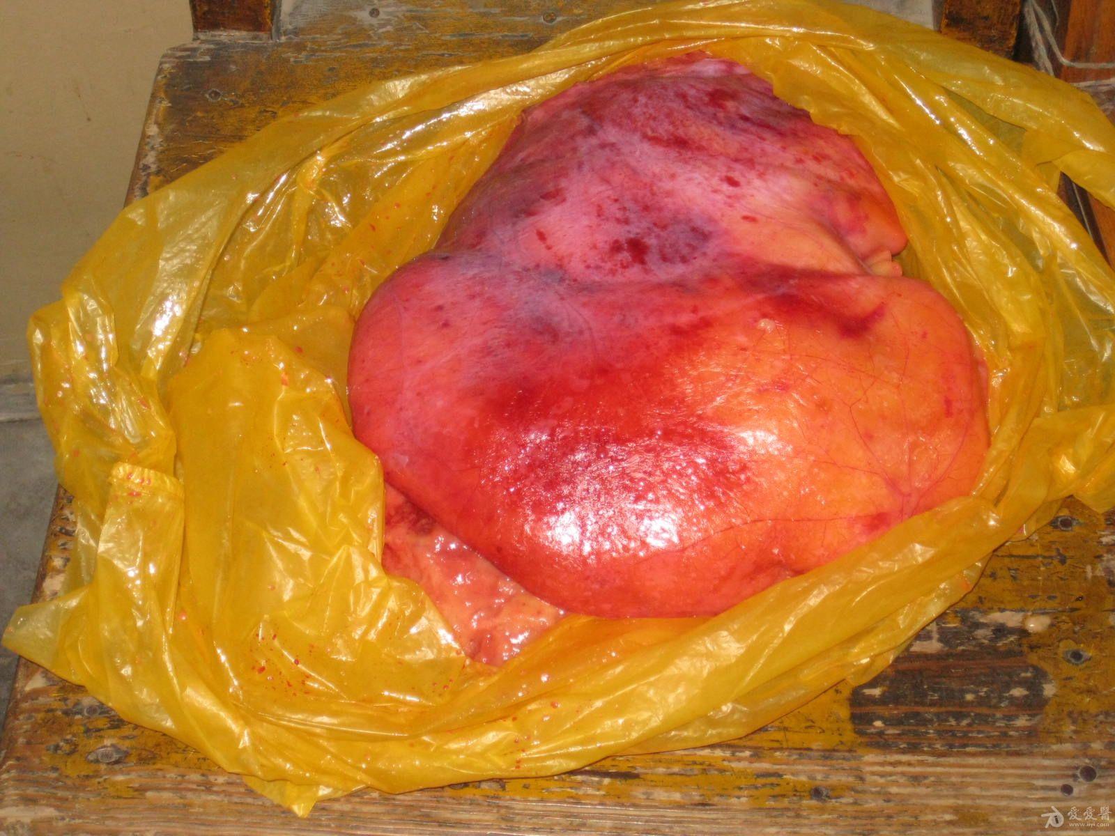 胸腔内的大脂肪瘤