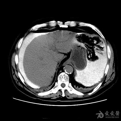 临床检查区 69 医学影像学讨论版 69 结肠癌钡灌肠后,肠穿孔