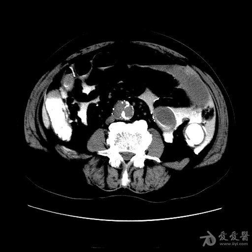 结肠癌钡灌肠后肠穿孔手术结果已公布20121219