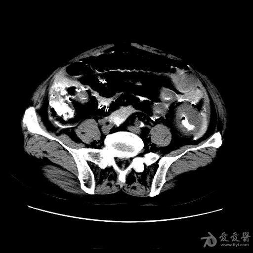 结肠癌钡灌肠后肠穿孔手术结果已公布20121219