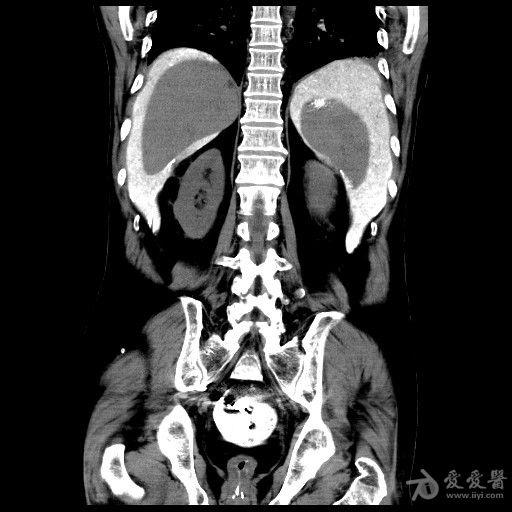 临床检查区 69 医学影像学讨论版 69 结肠癌钡灌肠后,肠穿孔