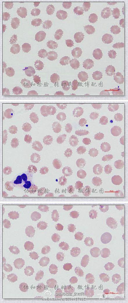 精彩微博分享—棘形红细胞(acanthocyte-by 协和张时民