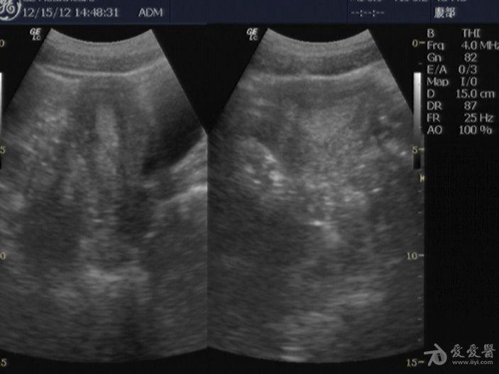 马鞍状子宫? - 超声医学讨论版 - 爱爱医医学论坛
