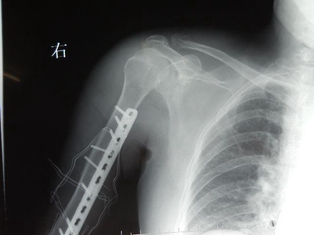 术后肩关节正位.jpg