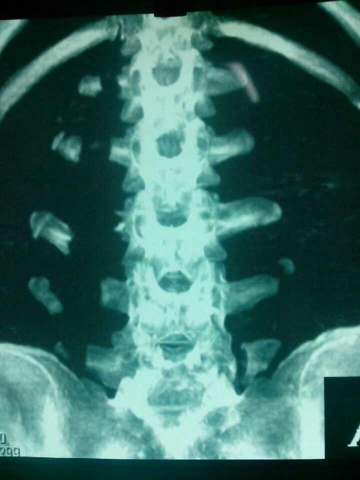 求助临床椎弓骨折与椎弓峡部裂如果鉴别