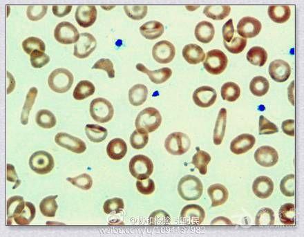 精彩微博分享--异常形态红细胞-看看有几种形态?