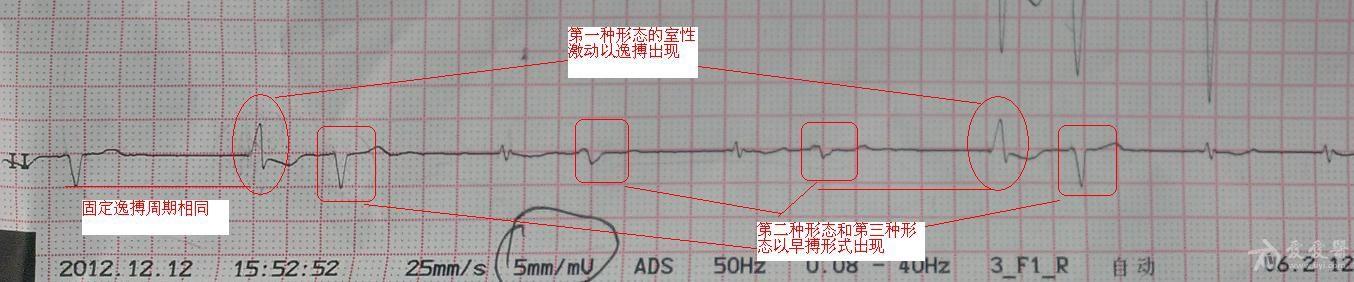 讨论心电图(房颤)