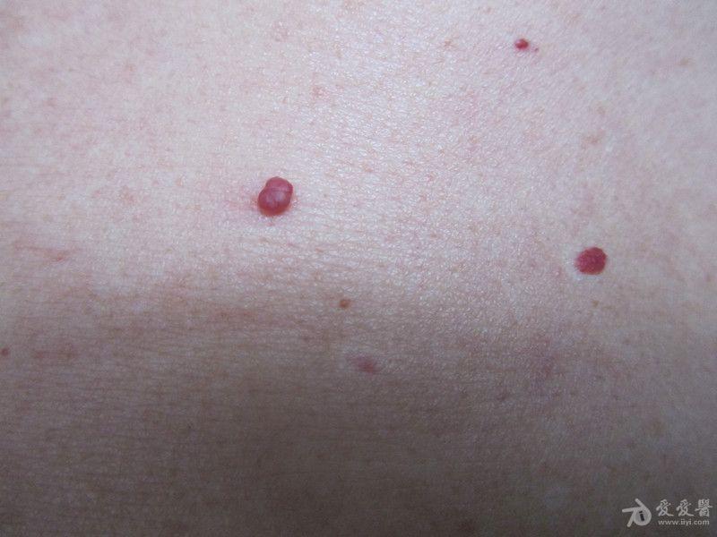 中年男士躯干部的红色丘疹—— 樱桃状血管瘤