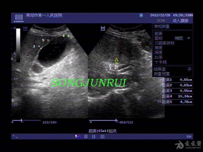 超声入门贴13-----胆囊管结石伴急性胆囊炎