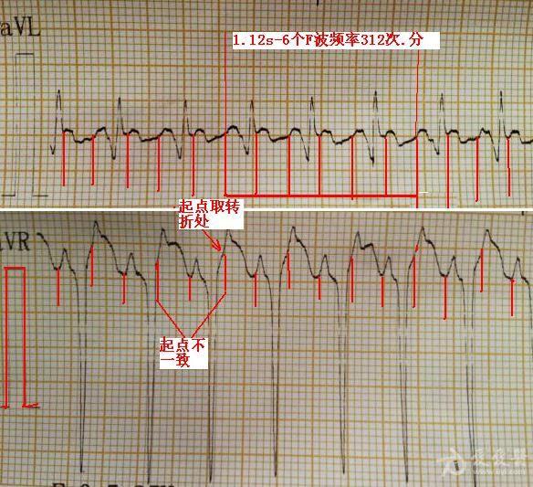 请大家帮忙看一下这是房速不 心电图脑电图专业讨论版 爱爱医医