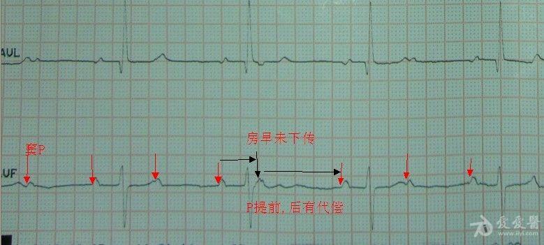 二度ii型房室传导阻滞?