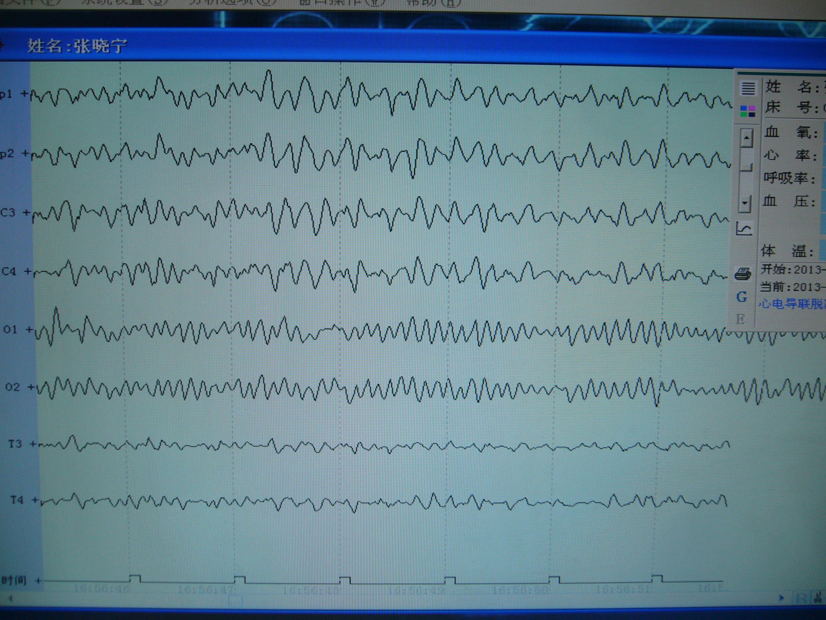 脑电图病例