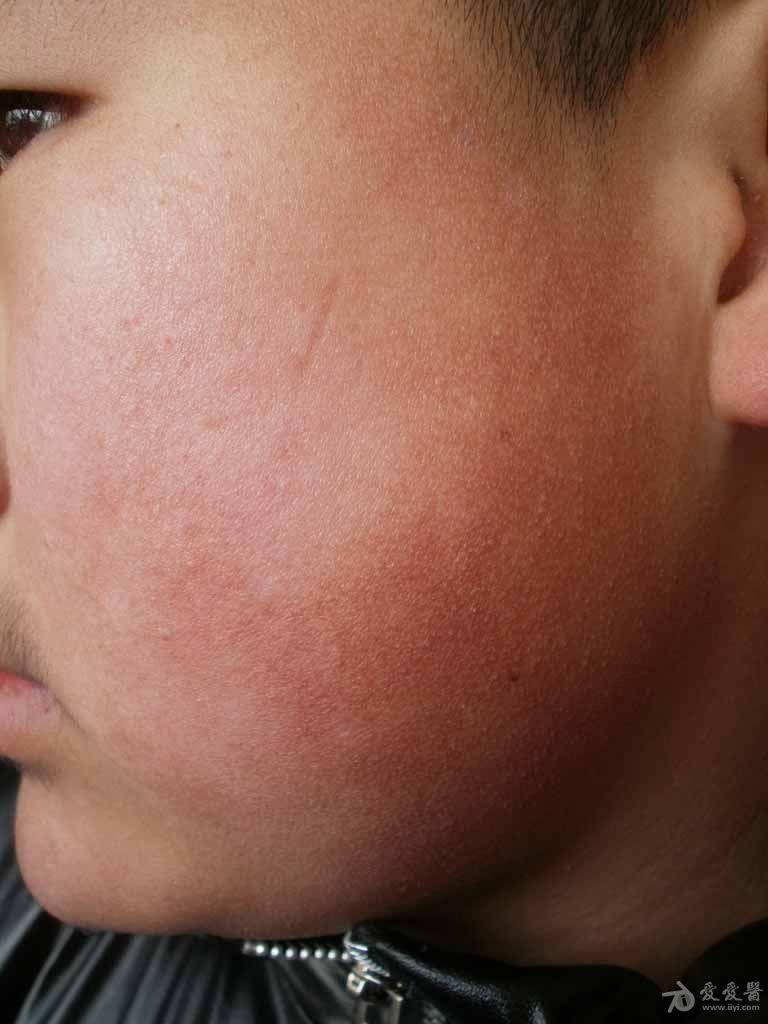 典型病例分享:面颈部毛囊红斑黑变病及白色糠疹.
