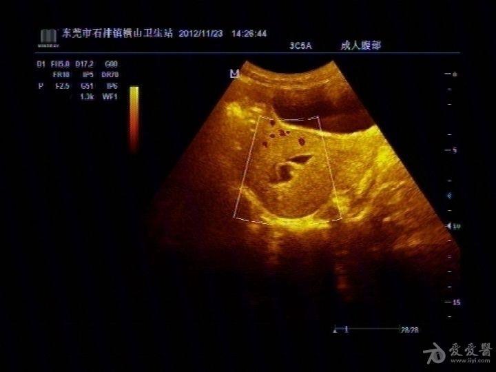 宫腔残留物怎么区别?