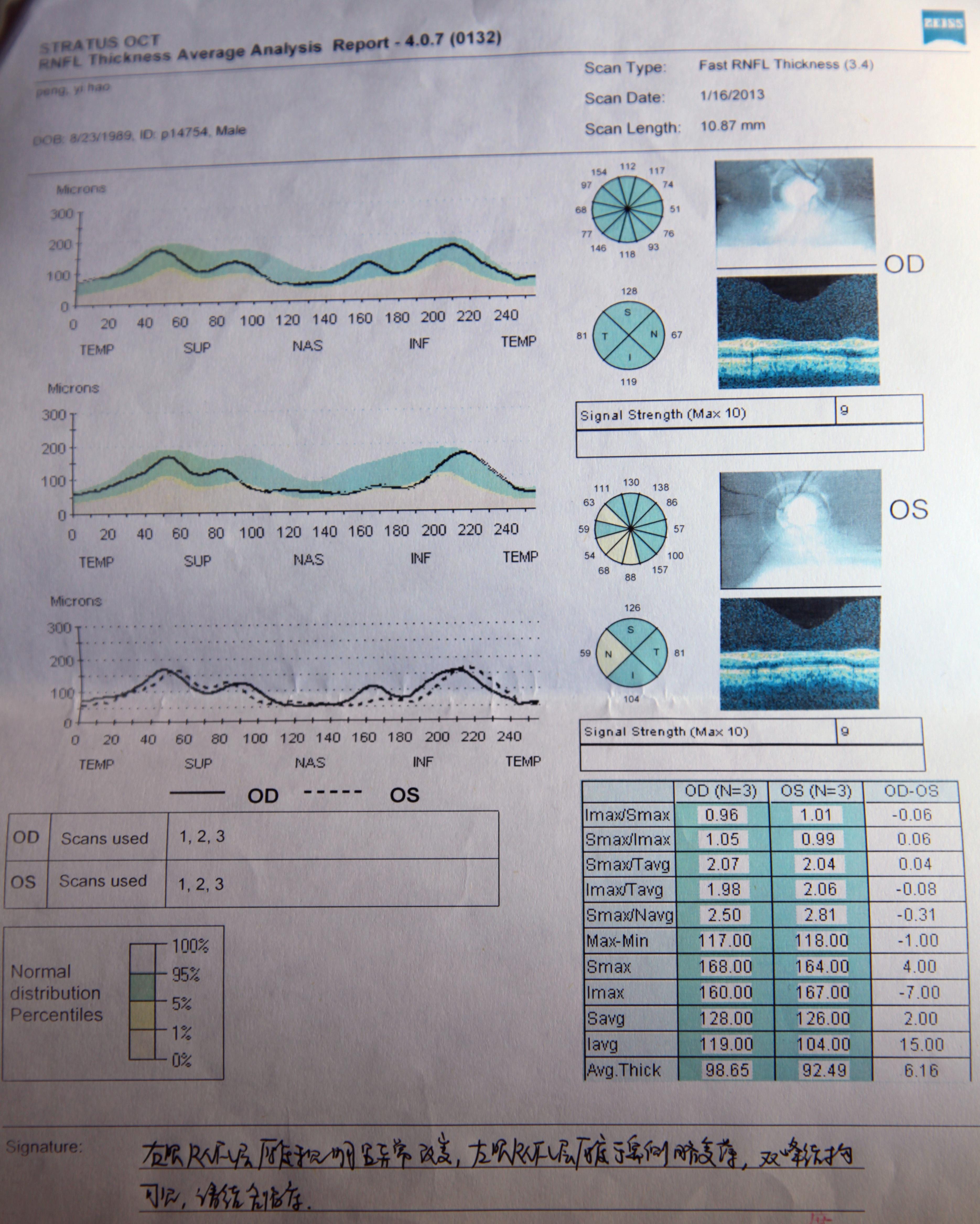 求大家帮我看看我的oct,视野,眼压检查报告单.
