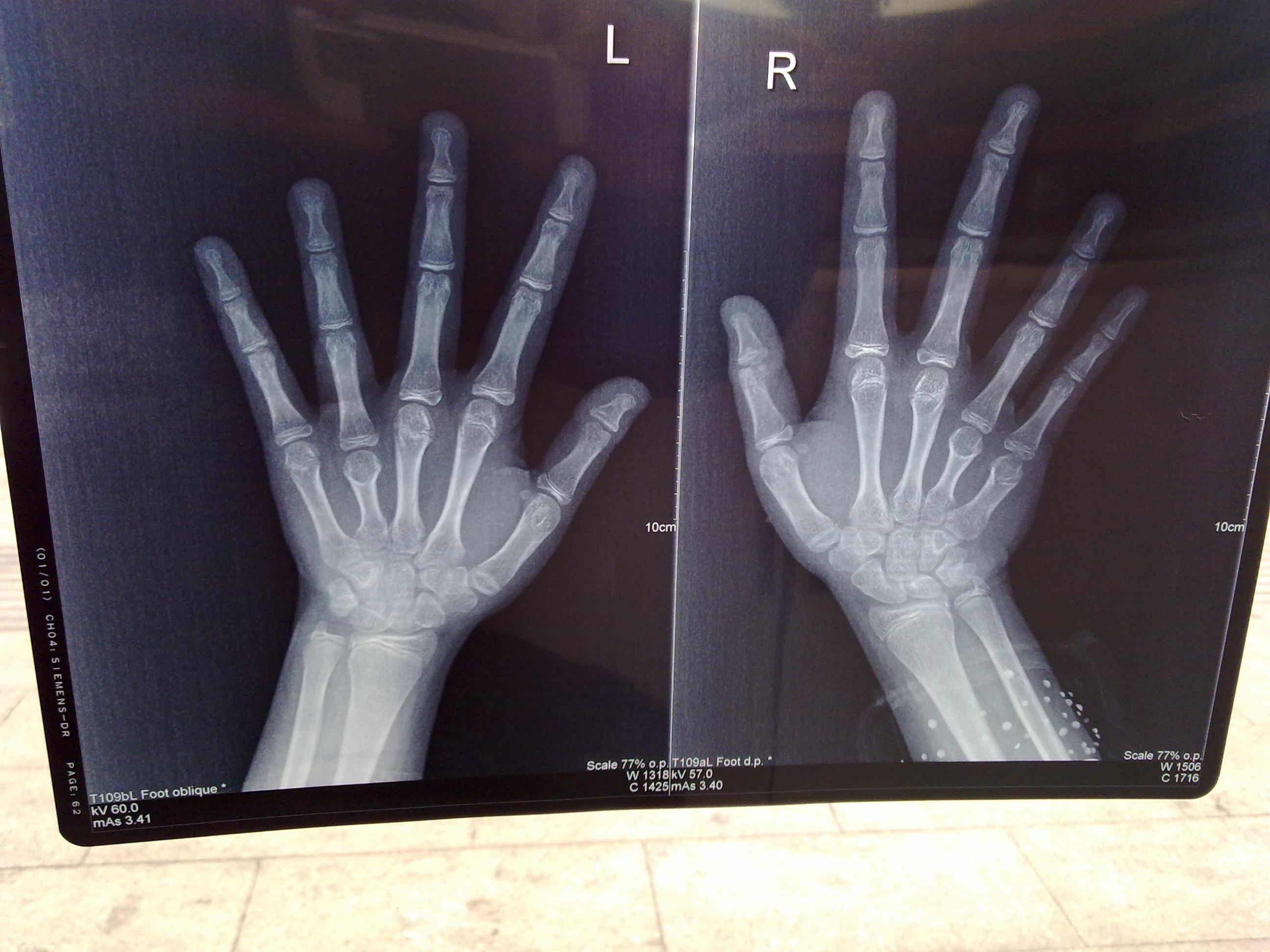 大家帮我看张手指的x光片