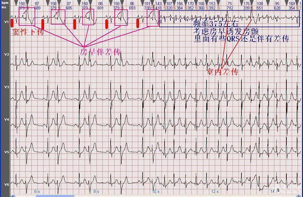 心电图读图第十六期(参考答案已公布)