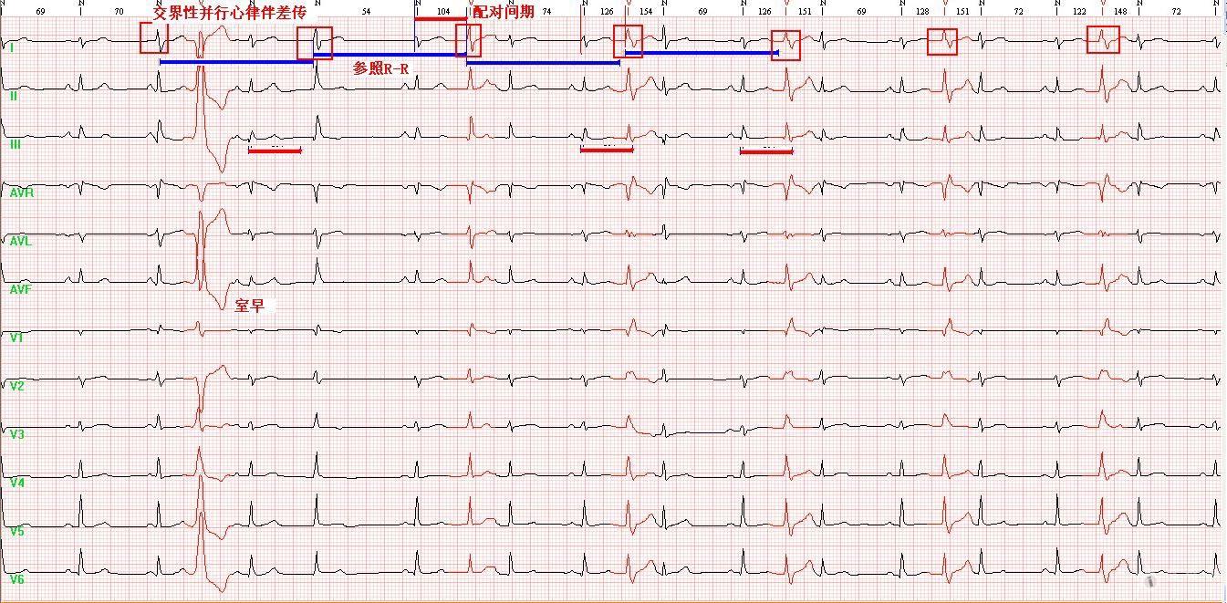 心电图分析请教各位老师