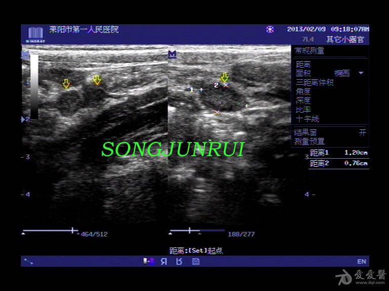 超声入门贴24-小儿肠系膜淋巴结炎