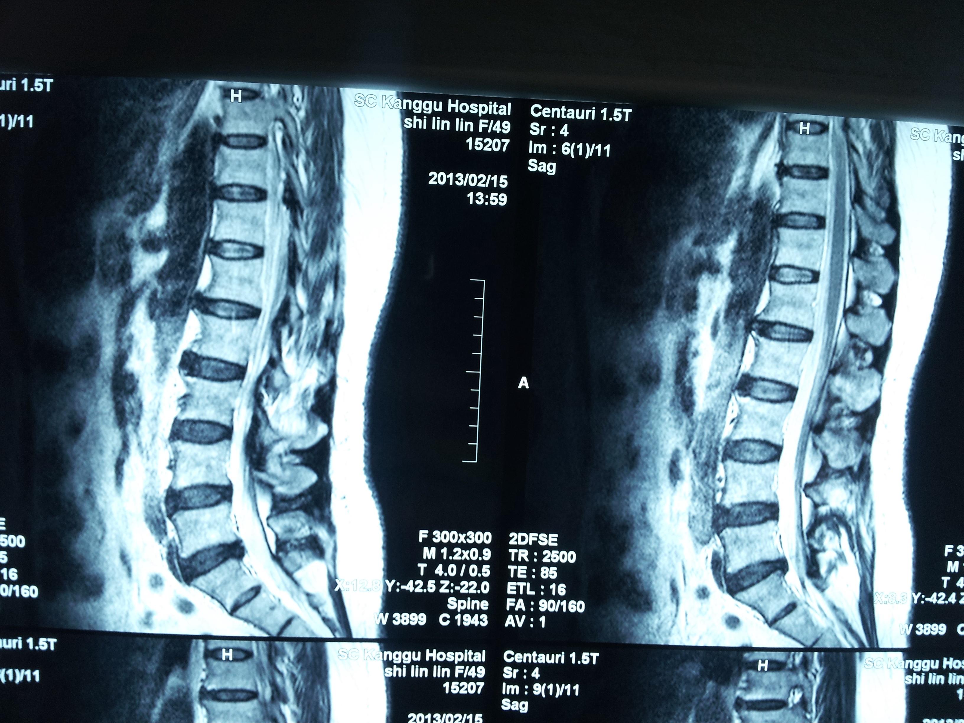 腰5骶1椎间盘脱出症腰45椎间盘突出